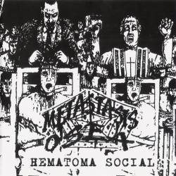Metastasis Osea : Hematoma Social